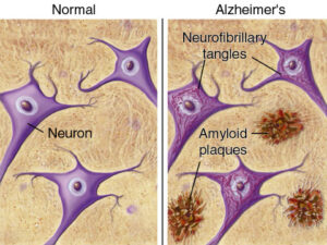 Alzheimer cannabinoidi