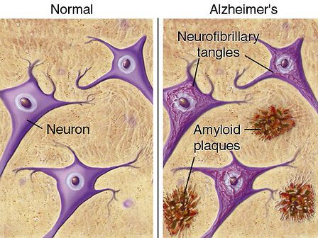 La perdita di cannabinoidi come causa dell&amp;#039;Alzheimer
