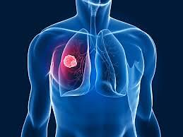 THC e CBD favoriscono la distruzione delle cellule del cancro al polmone da parte delle cellule immunitarie