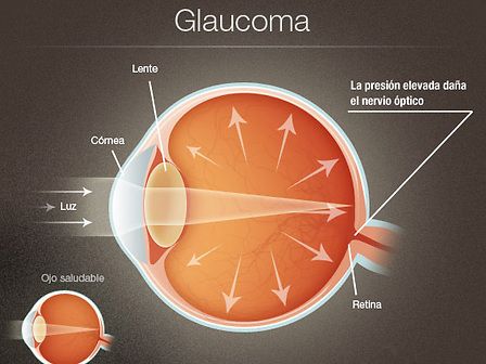 I pro e i contro nell&amp;#039;utilizzo della cannabis contro il glaucoma