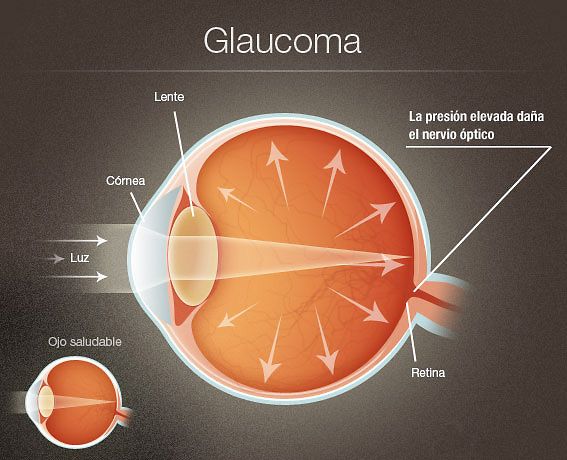 I pro e i contro nell&#039;utilizzo della cannabis contro il glaucoma