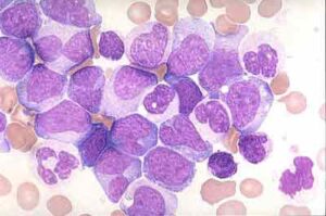 leucemia-mieloide-cronica