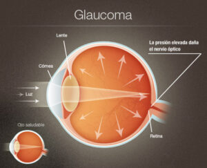 glaucoma